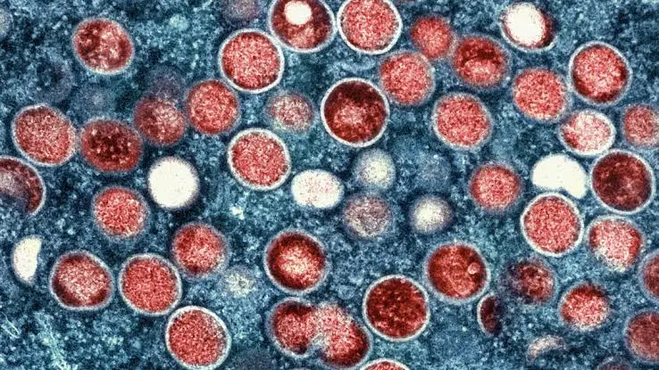 Bilim Dünyası Alarmda: Mpox Virüsü Küresel Salgın Riski Taşıyor